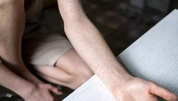 ABD’de Kızamık Vaka Sayısı 33 Yılın Zirvesinde