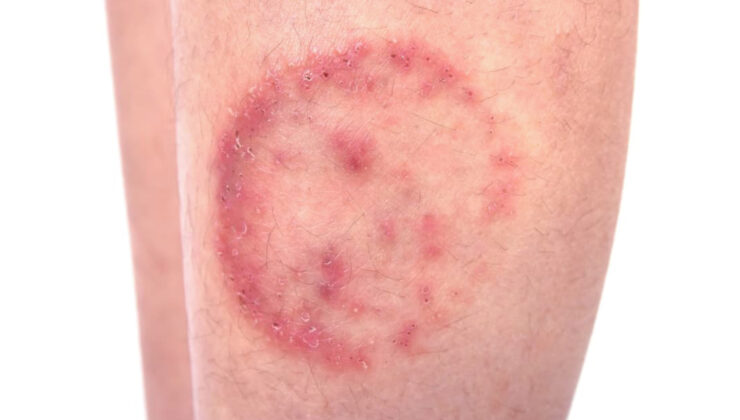 Uzmanı uyardı: Yaz aylarında mantar vakalarında artış yaşanıyor!