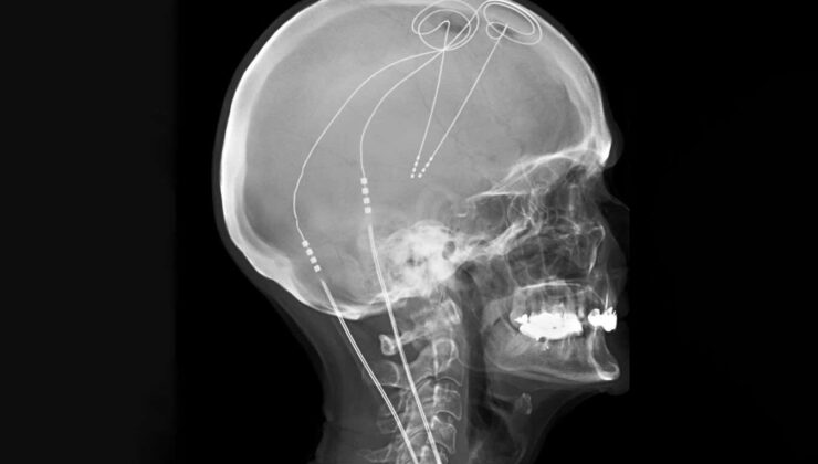 Ismarlama beyin implantı kronik ağrıdan uzun süreli rahatlama sağlar