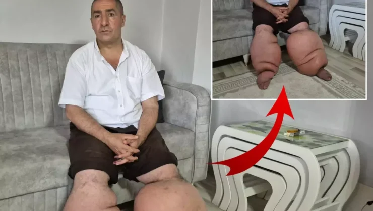 Yüksek ateş şikayetiyle hastaneye gitti, 15 yıldır “fil hastalığı” ile mücadele ediyor