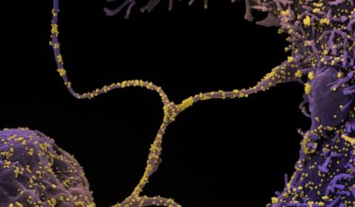 İyileşen COVID-19 Hastalarının Taramaları Beyindeki Mikroyapısal Değişiklikleri Ortaya Çıkardı