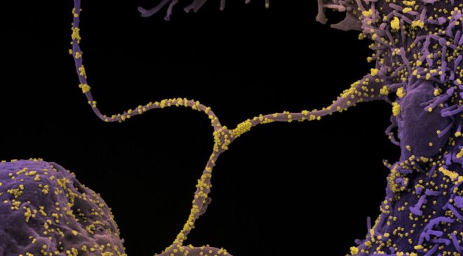 İyileşen COVID-19 Hastalarının Taramaları Beyindeki Mikroyapısal Değişiklikleri Ortaya Çıkardı