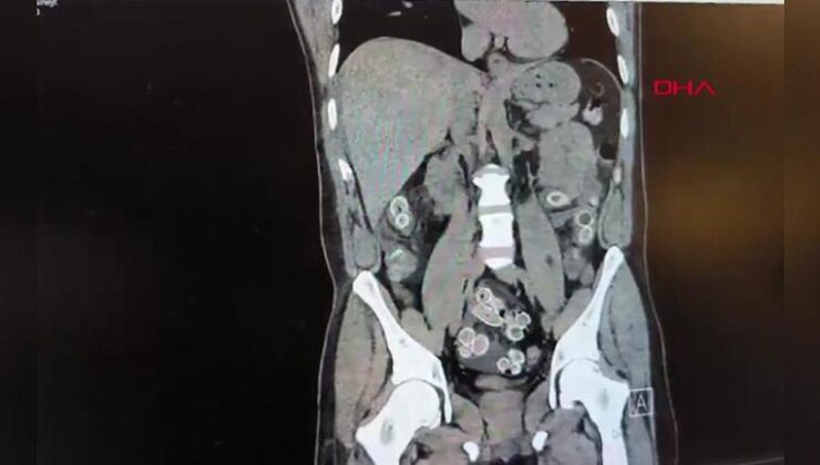 Midesinde paket paket uyuşturucu taşıdı – Son Dakika Haberler CNN Türk | Video