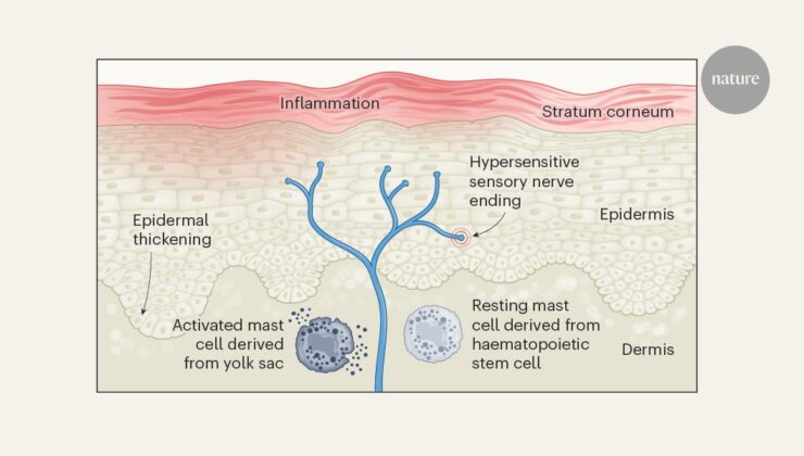 Çocukluk egzaması annenin hamilelik sırasındaki stresiyle bağlantılı