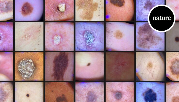 Yapay zekaya karşı cilt kanseri: dermatoloji tanısının geleceği