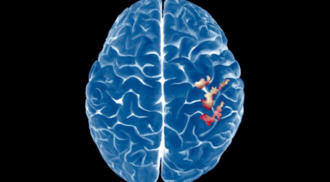 Beynin Vücut Haritası Şaşırtıcı Şekilde Kararlı – Bir Uzuv Kaybedildikten Sonra Bile