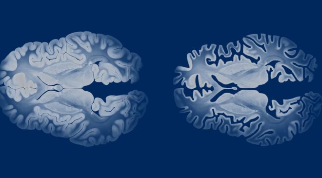 Deneysel Alzheimer İlacı, Belirtiler Başlamadan Hastalığı Durdurma Gücüne Sahip Olabilir