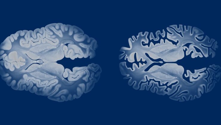 Deneysel Alzheimer İlacı, Belirtiler Başlamadan Hastalığı Durdurma Gücüne Sahip Olabilir