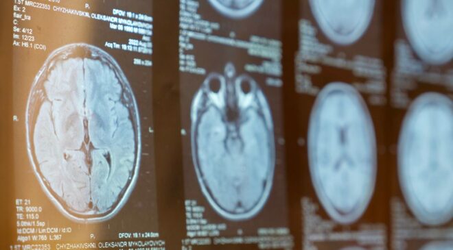 İki MS Alt Tipinin Çığır Açan Keşfi Yeni Hedefe Yönelik Tedavilere Yol Açabilir