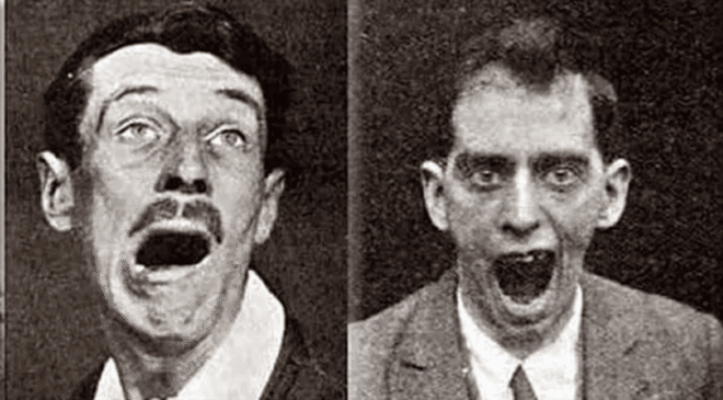 Ensefalit Lethargica: 500.000 Kişiyi Öldüren ve Sonra Aniden Ortadan Kaybolan Garip Hastalık