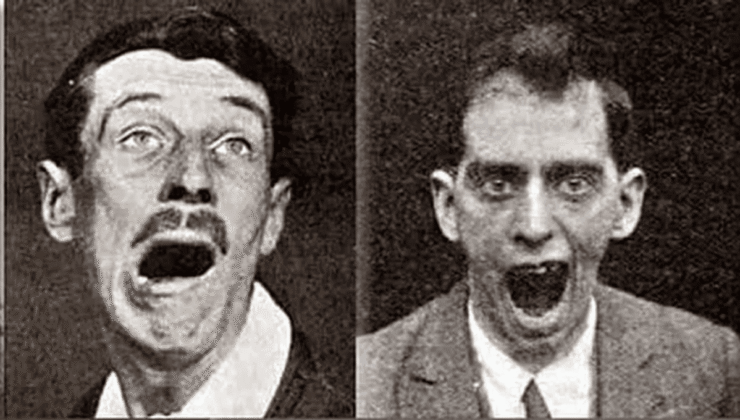 Ensefalit Lethargica: 500.000 Kişiyi Öldüren ve Sonra Aniden Ortadan Kaybolan Garip Hastalık