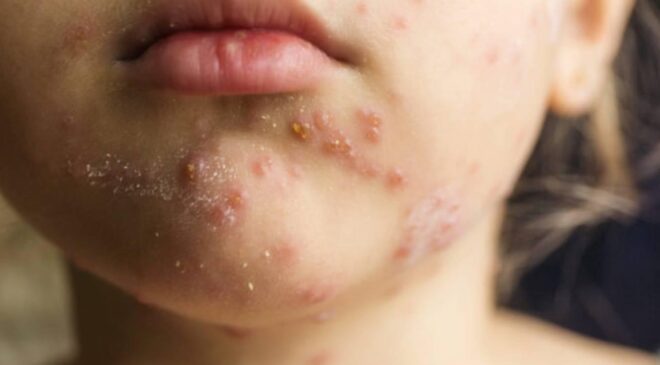 Prof. Dr. Kara'dan kızamık uyarısı: Bir kişi 18 kişiye bulaştırabilir