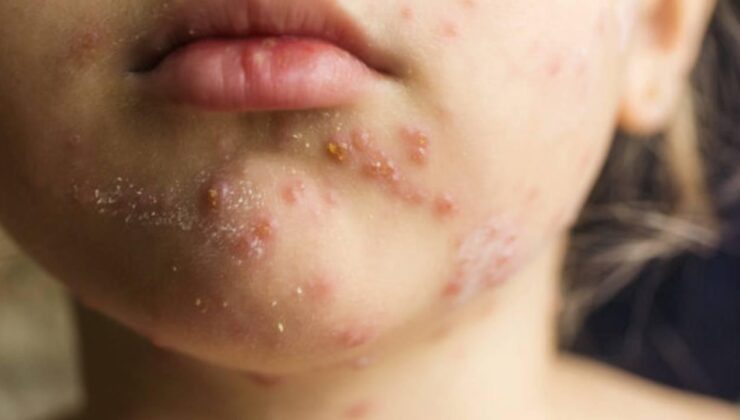 Prof. Dr. Kara'dan kızamık uyarısı: Bir kişi 18 kişiye bulaştırabilir