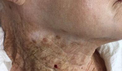 40+ Yıllık UV Hasarı: Bu Şaşırtıcı Tıbbi Görüntü Boynunuza Neden Güneş Kremi Sürmeniz Gerektiğini Gösteriyor