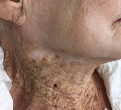 40+ Yıllık UV Hasarı: Bu Şaşırtıcı Tıbbi Görüntü Boynunuza Neden Güneş Kremi Sürmeniz Gerektiğini Gösteriyor