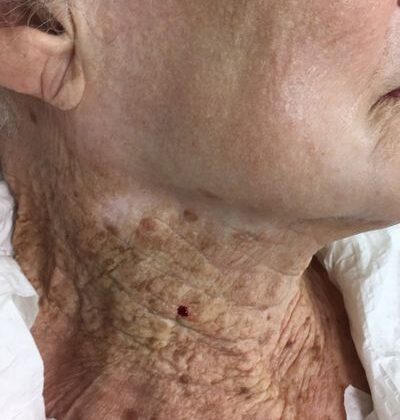 40+ Yıllık UV Hasarı: Bu Şaşırtıcı Tıbbi Görüntü Boynunuza Neden Güneş Kremi Sürmeniz Gerektiğini Gösteriyor